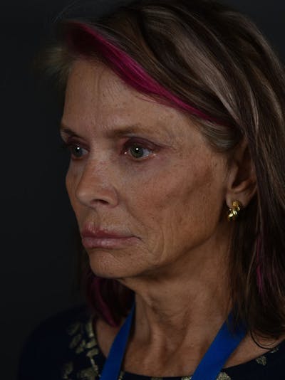 Neck Lift Before & After Gallery - Patient 792643 - Image 1