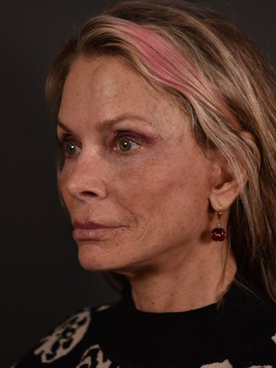 Neck Lift Before & After Gallery - Patient 792643 - Image 2