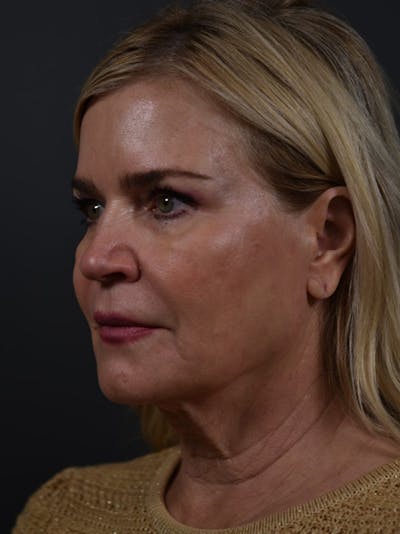 Neck Lift Before & After Gallery - Patient 378540 - Image 1