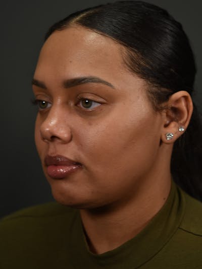 Neck Lift Before & After Gallery - Patient 152943 - Image 2