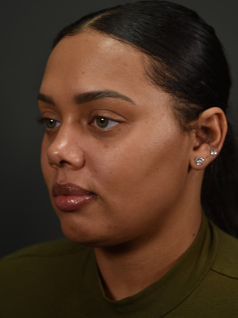 Neck Lift Before & After Gallery - Patient 152943 - Image 2