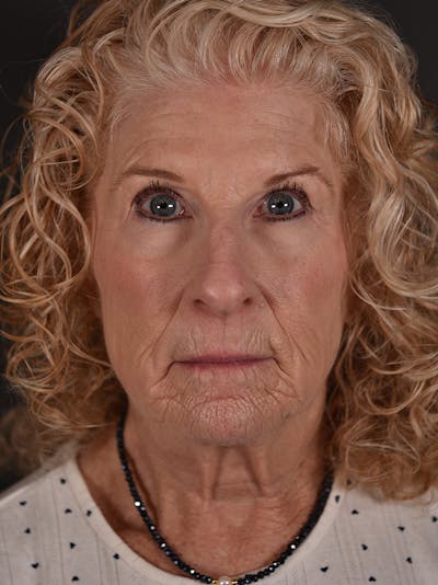 Blepharoplasty (Eyelid Surgery) Before & After Gallery - Patient 270091 - Image 1