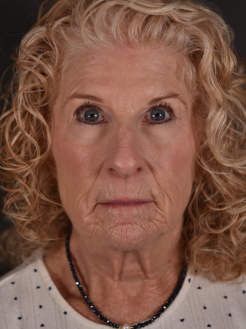 Blepharoplasty (Eyelid Surgery) Before & After Gallery - Patient 270091 - Image 1