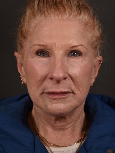 Blepharoplasty (Eyelid Surgery) Before & After Gallery - Patient 270091 - Image 2