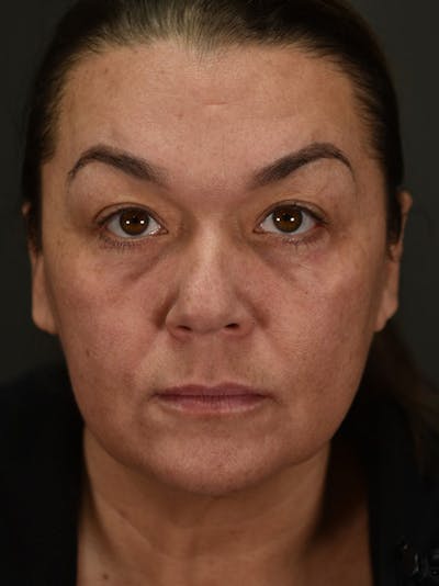 Blepharoplasty (Eyelid Surgery) Before & After Gallery - Patient 353501 - Image 2