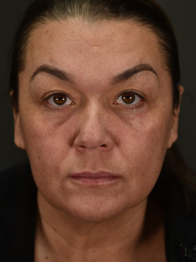 Blepharoplasty (Eyelid Surgery) Before & After Gallery - Patient 353501 - Image 2
