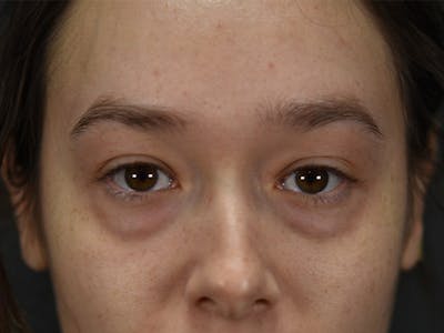 Blepharoplasty (Eyelid Surgery) Before & After Gallery - Patient 353942 - Image 1