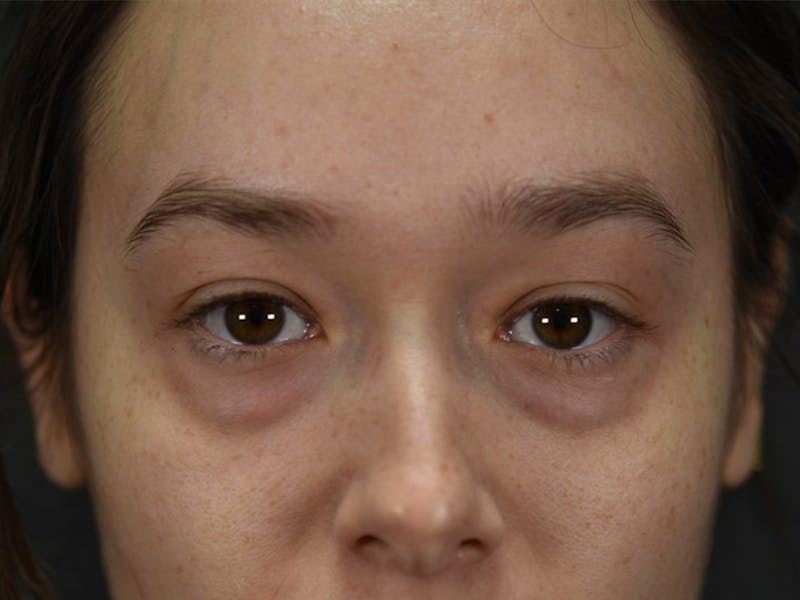Blepharoplasty (Eyelid Surgery) Before & After Gallery - Patient 353942 - Image 1