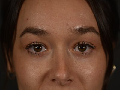 Blepharoplasty (Eyelid Surgery) Before & After Gallery - Patient 353942 - Image 2