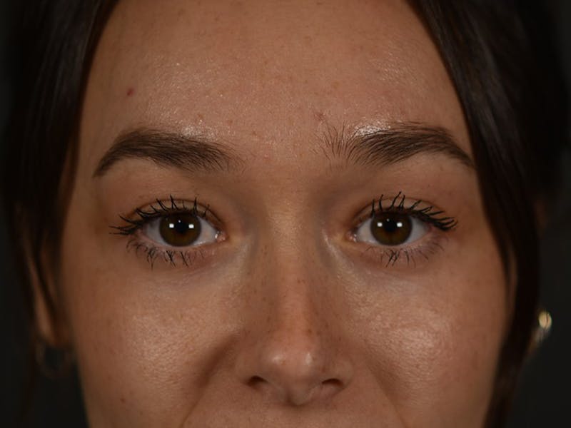 Blepharoplasty (Eyelid Surgery) Before & After Gallery - Patient 353942 - Image 2