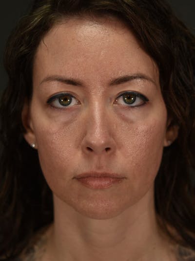 Blepharoplasty (Eyelid Surgery) Before & After Gallery - Patient 381898 - Image 1