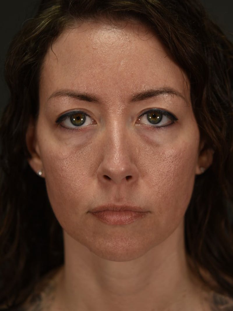 Blepharoplasty (Eyelid Surgery) Before & After Gallery - Patient 381898 - Image 1