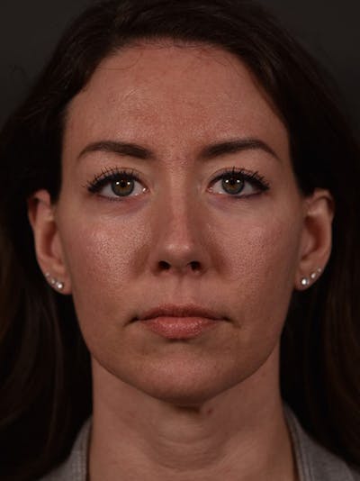 Blepharoplasty (Eyelid Surgery) Before & After Gallery - Patient 381898 - Image 2