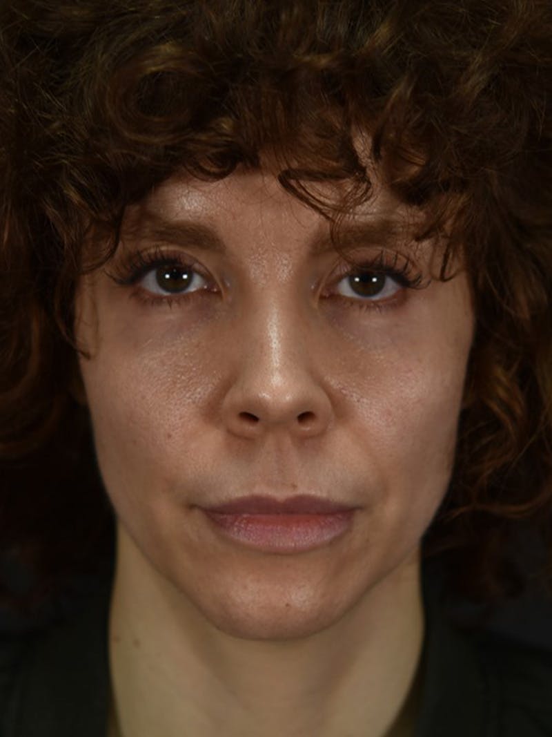 Lip Lift Before & After Gallery - Patient 307502 - Image 1
