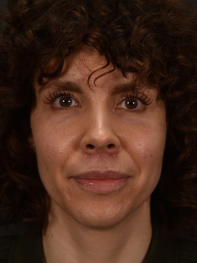 Lip Lift Before & After Gallery - Patient 307502 - Image 2