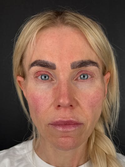 Temple Filler Before & After Gallery - Patient 143149 - Image 1