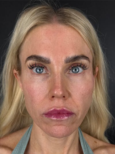 Temple Filler Before & After Gallery - Patient 143149 - Image 2