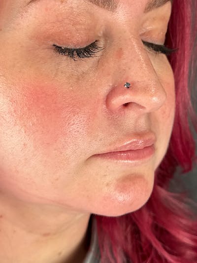 Lip Filler Before & After Gallery - Patient 233172 - Image 1