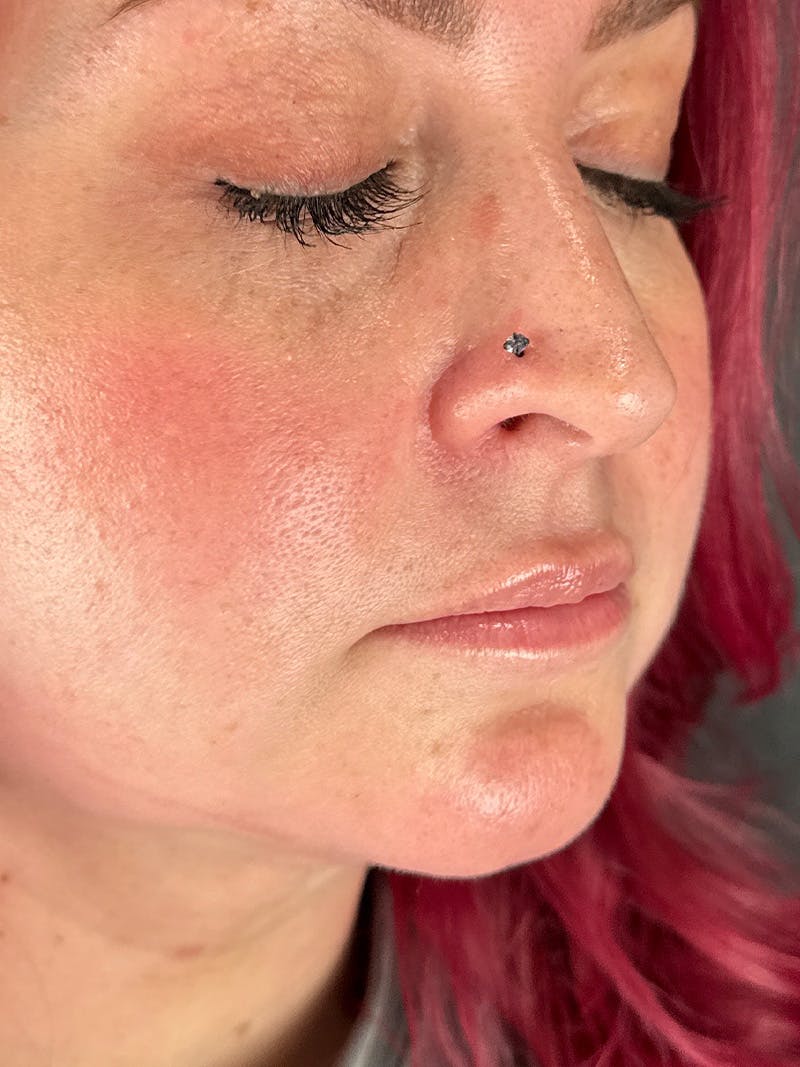 Lip Filler Before & After Gallery - Patient 233172 - Image 1