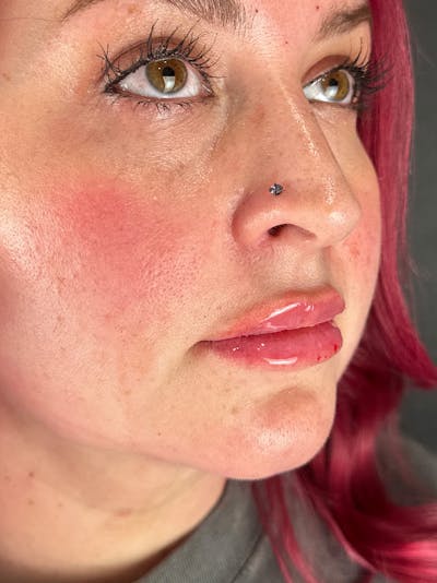 Lip Filler Before & After Gallery - Patient 233172 - Image 2