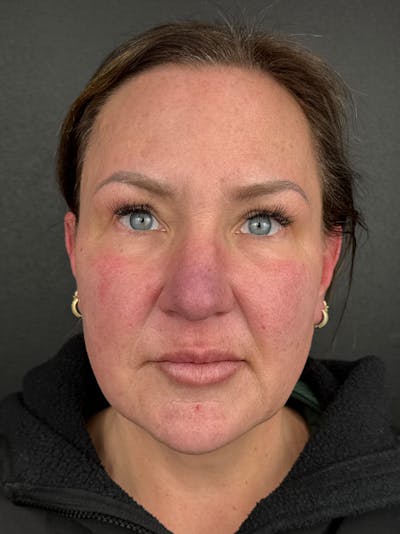 Full Facial Filler Before & After Gallery - Patient 192363 - Image 1