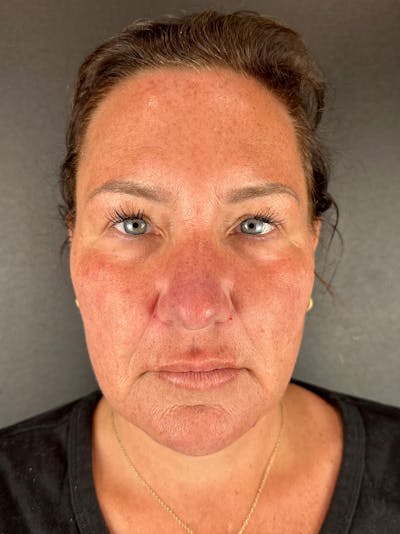 Full Facial Filler Before & After Gallery - Patient 192363 - Image 2