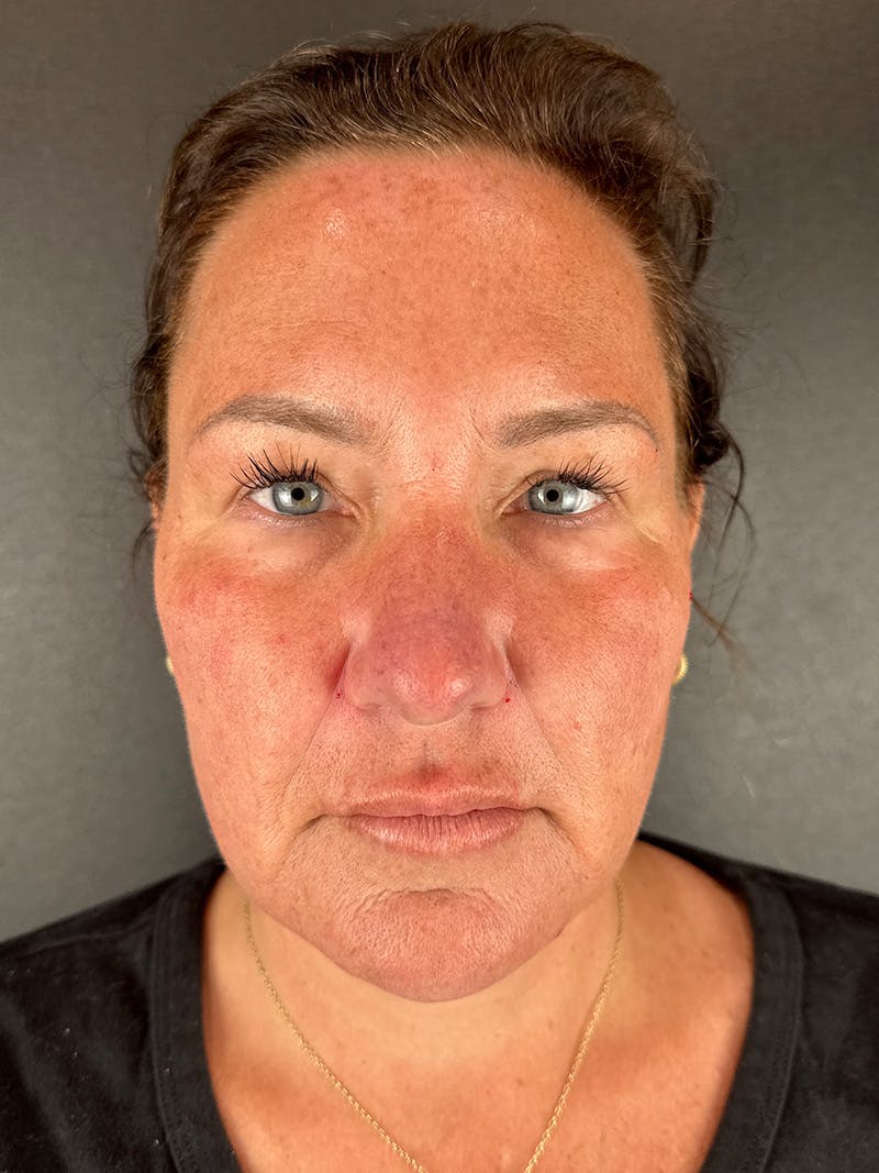 Full Facial Filler Before & After Gallery - Patient 192363 - Image 2
