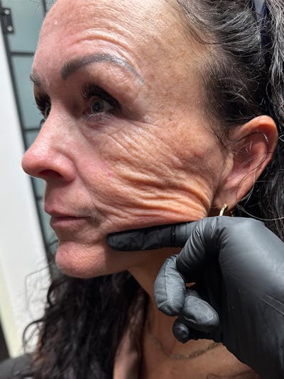 Radiesse Before & After Gallery - Patient 887708 - Image 1