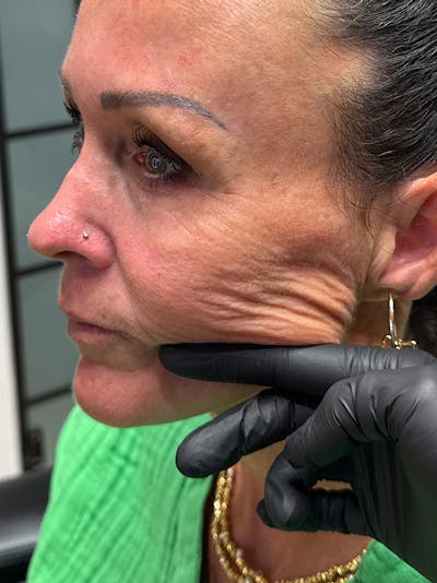Radiesse Before & After Gallery - Patient 887708 - Image 2