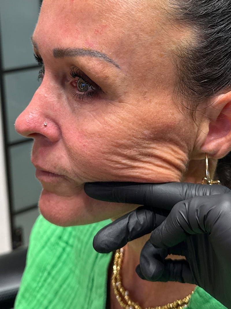 Radiesse Before & After Gallery - Patient 887708 - Image 2