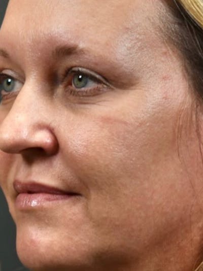 Laser Resurfacing Before & After Gallery - Patient 146673 - Image 1