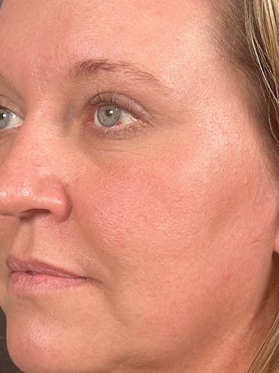 Laser Resurfacing Before & After Gallery - Patient 146673 - Image 2