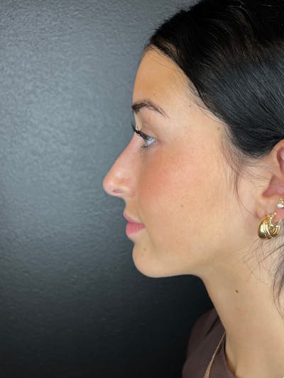 Liquid Rhinoplasty Before & After Gallery - Patient 127593 - Image 2