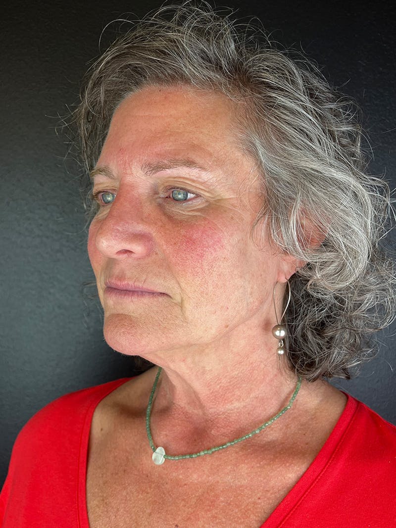 Comprehensive Treatment Plans Before & After Gallery - Patient 343538 - Image 3