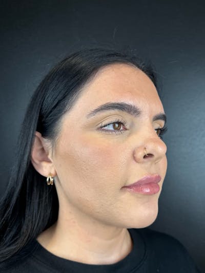 RF Microneedling Before & After Gallery - Patient 268027 - Image 2