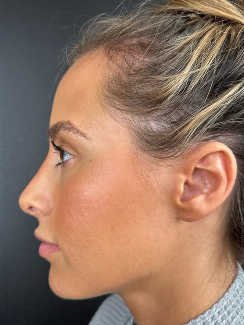 Hairline Advancement Before & After Gallery - Patient 115833 - Image 1