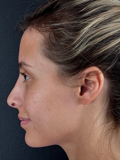Hairline Advancement Before & After Gallery - Patient 115833 - Image 2