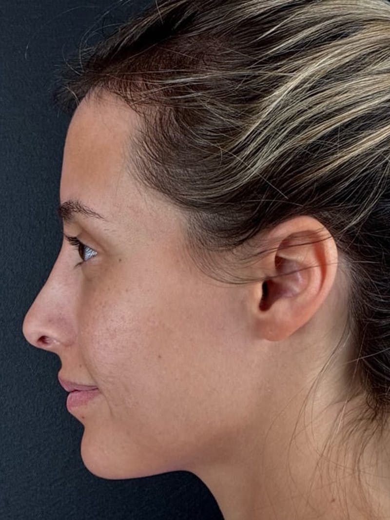 Hairline Advancement Before & After Gallery - Patient 115833 - Image 2