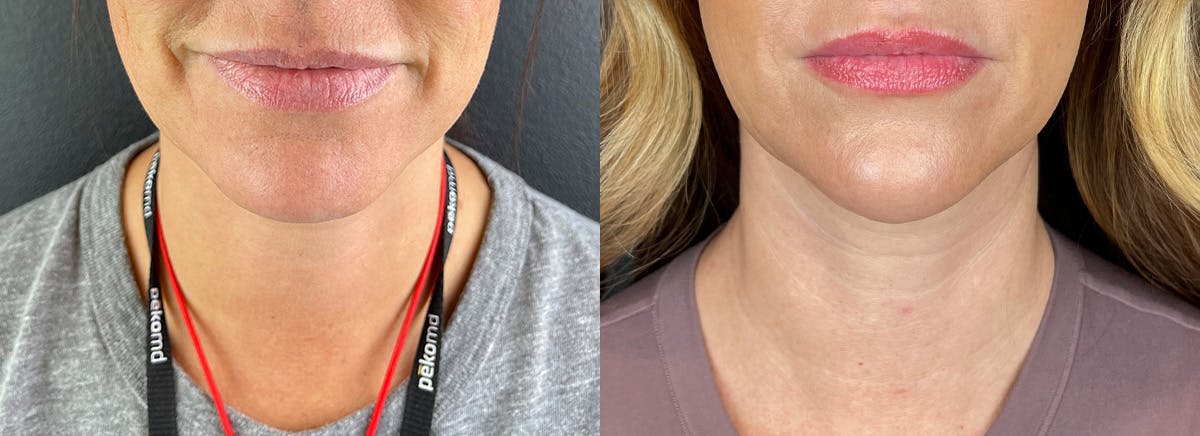 Chin Filler Before & After Gallery - Patient 403572 - Image 1
