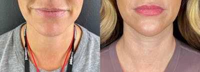 Chin Filler Before & After Gallery - Patient 403572 - Image 1