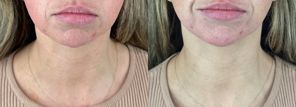 Chin Filler Before & After Gallery - Patient 209240 - Image 3