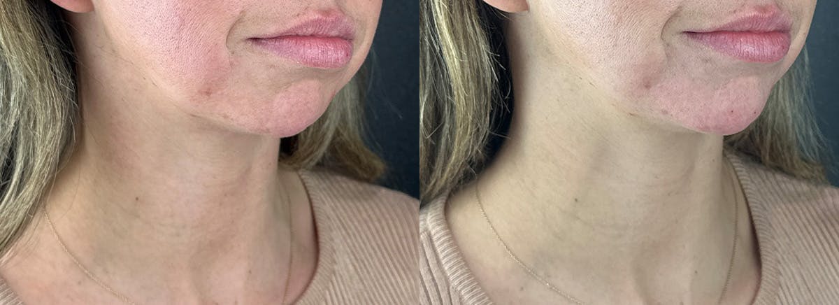 Chin Filler Before & After Gallery - Patient 209240 - Image 2