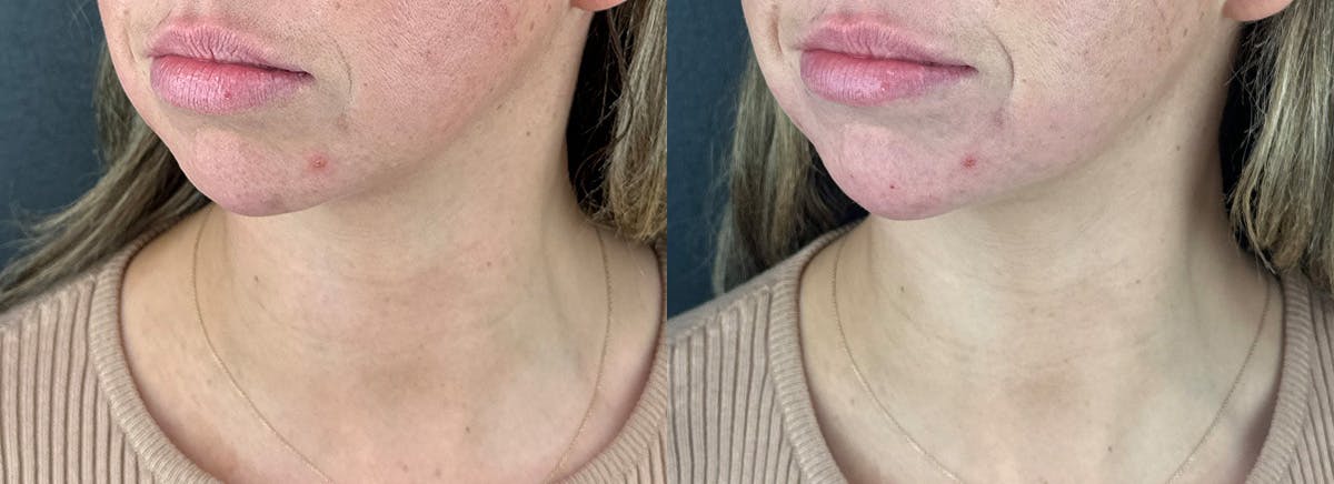 Chin Filler Before & After Gallery - Patient 209240 - Image 4
