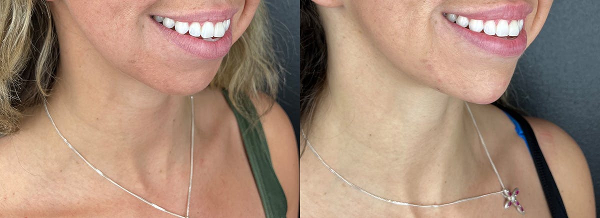 Chin Filler Before & After Gallery - Patient 209240 - Image 1