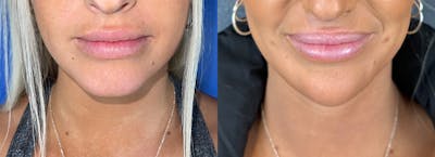 Chin Filler Before & After Gallery - Patient 111494 - Image 1