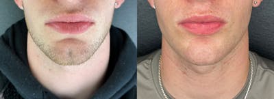 Chin Filler Before & After Gallery - Patient 496980 - Image 1