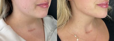 Chin Filler Before & After Gallery - Patient 397345 - Image 1