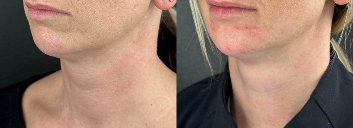Chin Filler Before & After Gallery - Patient 632529 - Image 1