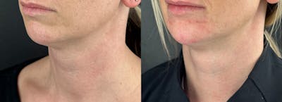 Chin Filler Before & After Gallery - Patient 632529 - Image 1