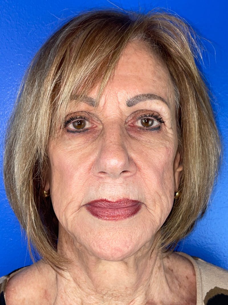 Renuvion Resurfacing Before & After Gallery - Patient 120023 - Image 1